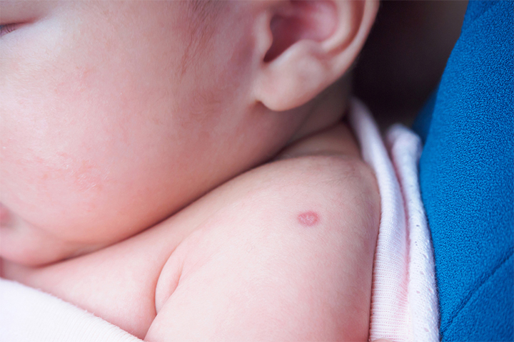 BCG vaccine can help prevent TB in babies