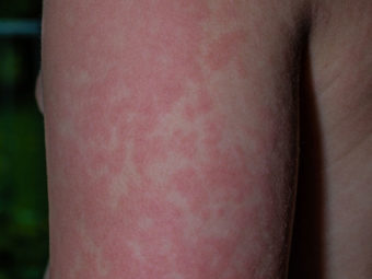 Fifth Disease In Children Causes, Symptoms, Treatment And Prevention