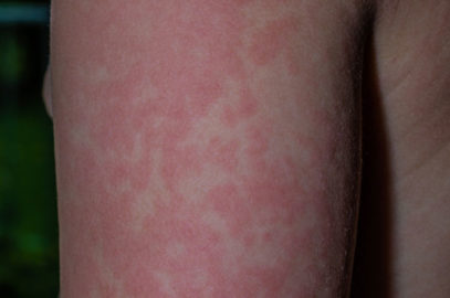 Fifth Disease In Children: Causes, Symptoms, Treatment And Prevention