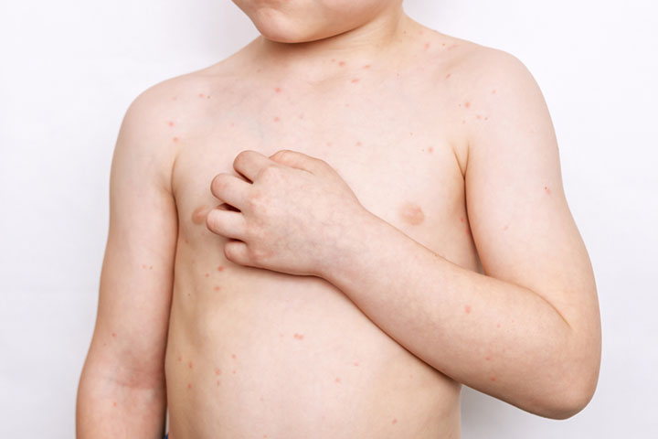 Fluid-filled blisters are a symptom of shingles in children