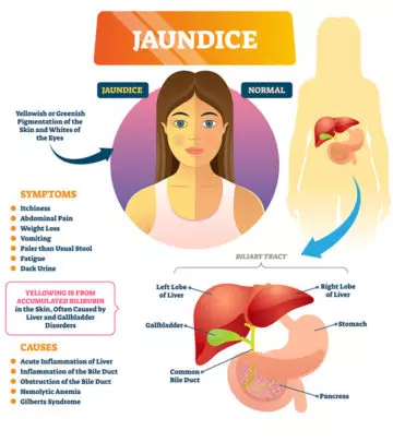 Jaundice In Children Causes, Symptoms, Treatment, And Home Remedies