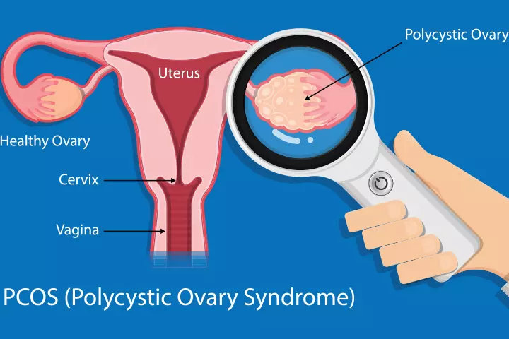 PCOS can raise the chances of cryptic pregnancy