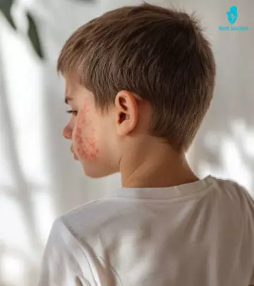 Fifth disease is a viral illness, the treatment of which is aimed at reducing symptoms.