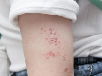 Shingles (Herpes zoster) In Children: Causes, Treatment And Prevention