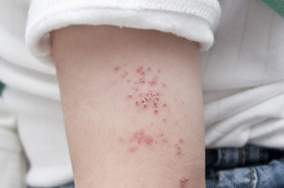 儿童中的带状疱疹（带状疱疹）：原因，治疗和预防