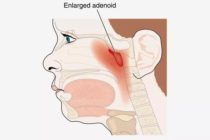 Adenoid may trap viruses