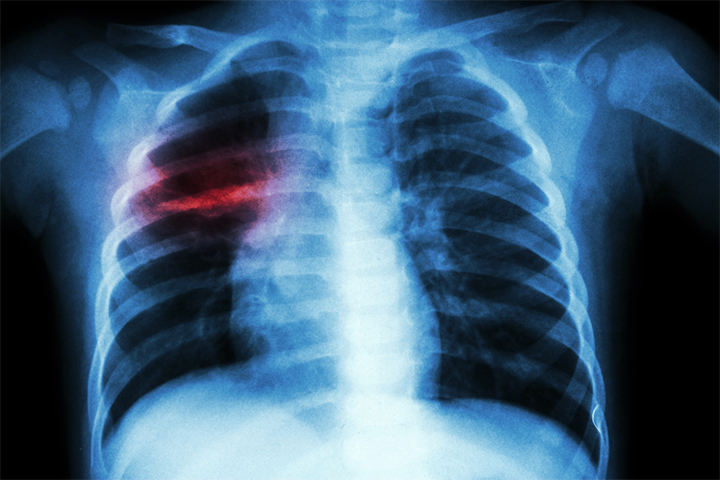 X-rays can help diagnose TB in children