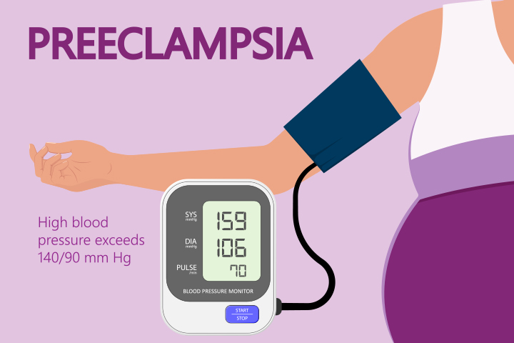Preeclampsia can also increase the chance of cesarean delivery