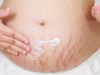5 Effective Tips To Prevent Stretch Marks During Pregnancy