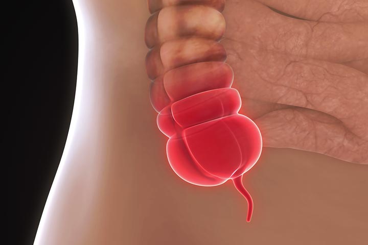 Appendicitis is a condition in which the appendix is infected and inflamed.