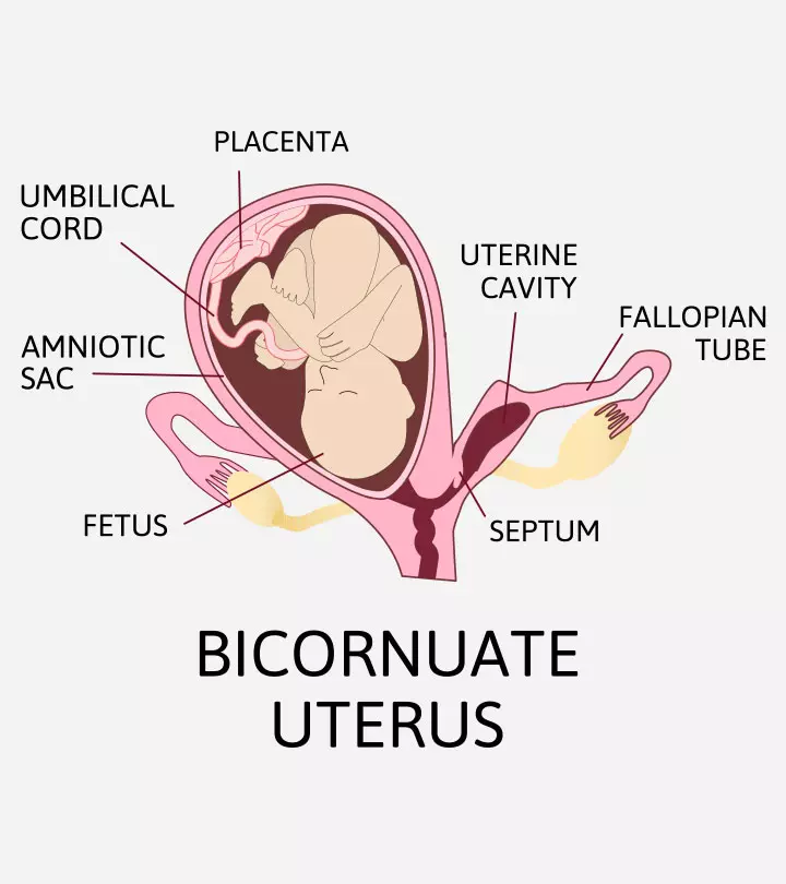 Bicornuate Uterus Symptoms, Causes, Diagnosis, And Treatment