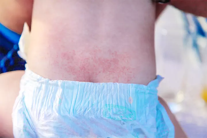 Diaper Rashes