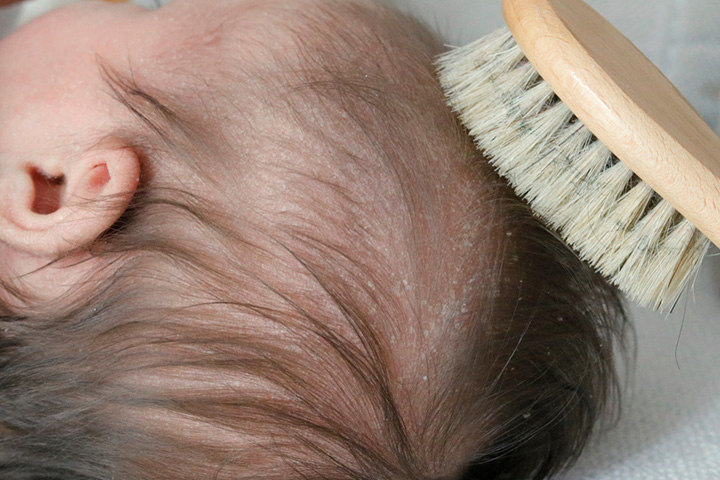 Don't Worry About The Cradle Cap