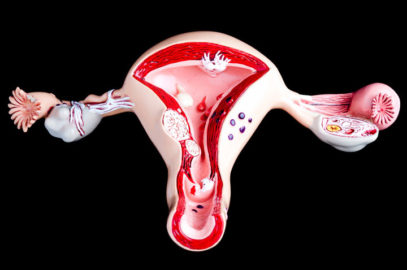 如何怀孕子宫内膜异位症？机会和最佳年龄