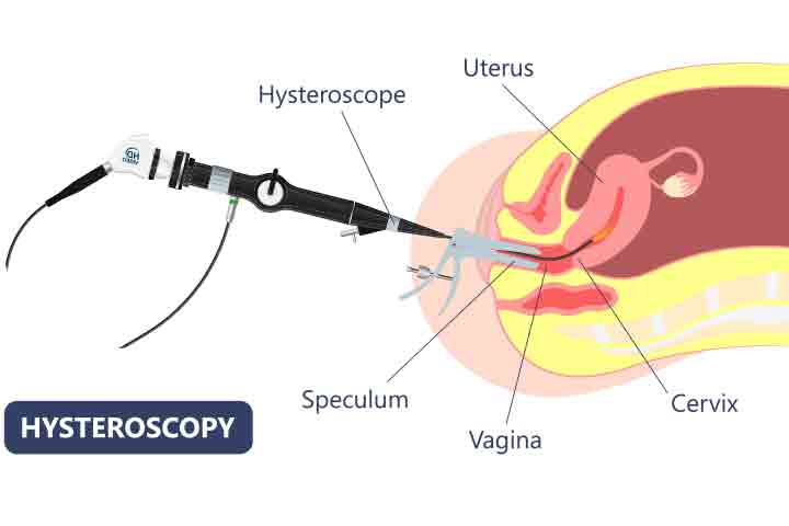 Hysteroscopy to diagnose bicornuate uterus