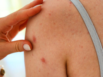 Rubella And Pregnancy: Causes, Symptoms, And Treatment