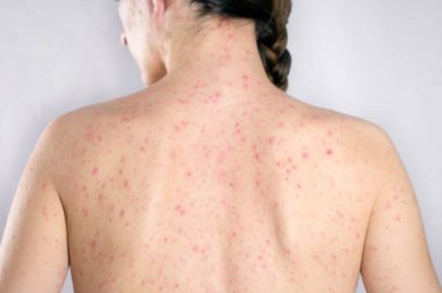 Shingles In Pregnancy: Causes, Symptoms And Treatment