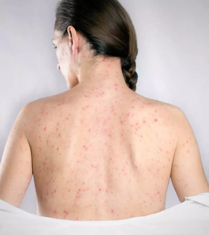 A Pregnant Woman Suffering From Shingles