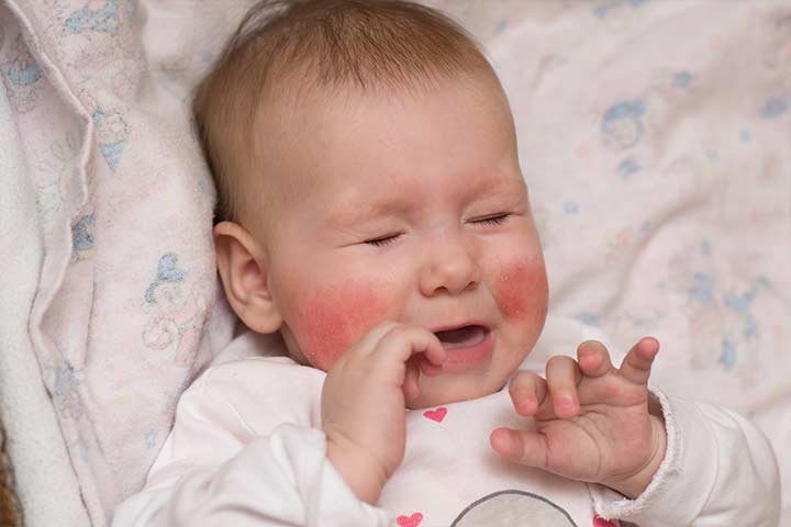How Common Is It For A New Baby To Have White Patches On Their Face