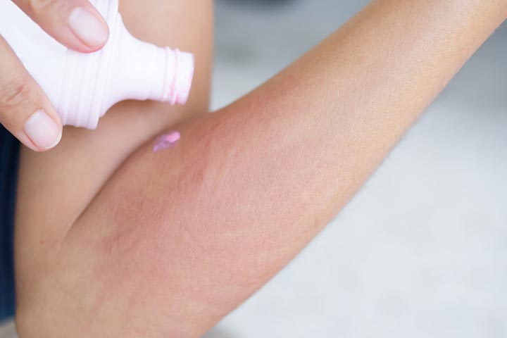 Calamine lotion can help get relief from itchiness
