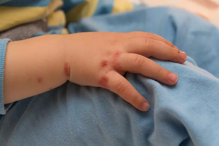Hand Foot And Mouth Disease