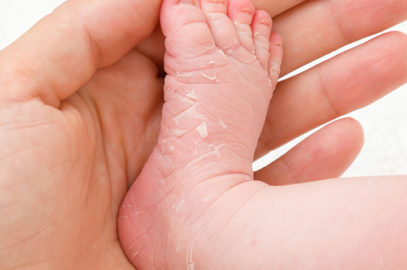 3 Reasons Your Baby’s Skin Is Dry And What You Can Do About It