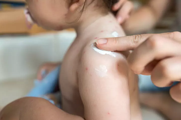 Apply skin creams on baby neck rash