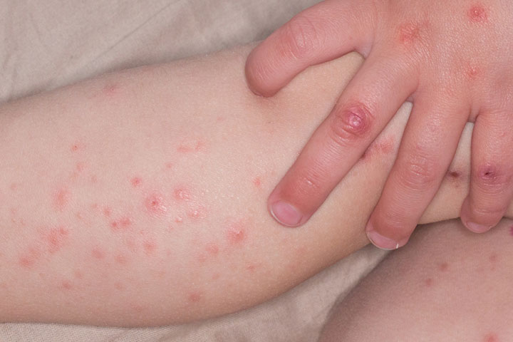 Cold hands may be caused by hand, foot, and mouth disease