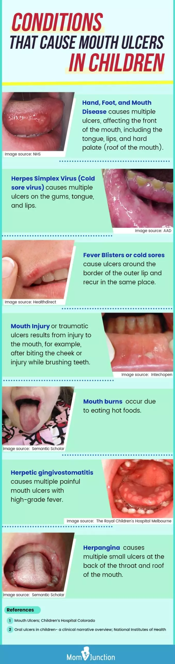 conditions that cause mouth ulcers in children (infographic)
