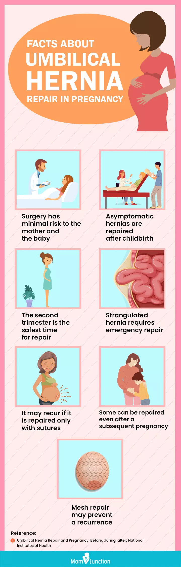facts about umbilical hernia repair during pregnancy (infographic)
