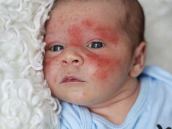 How To Manage Eczema In Babies