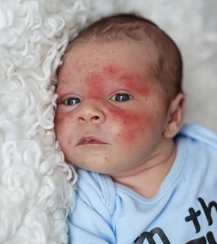 How To Manage Eczema In Babies_image