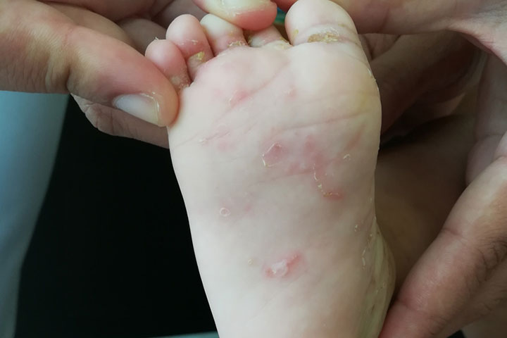 Scabies on baby's sole