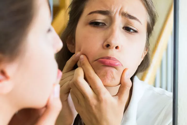 Teenager's skin acne