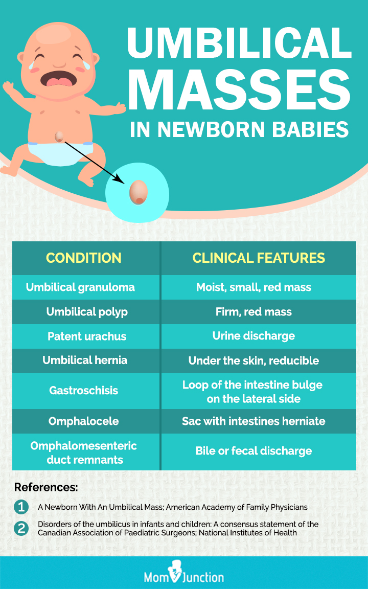 umbilical masses in newborn babies (infographic)