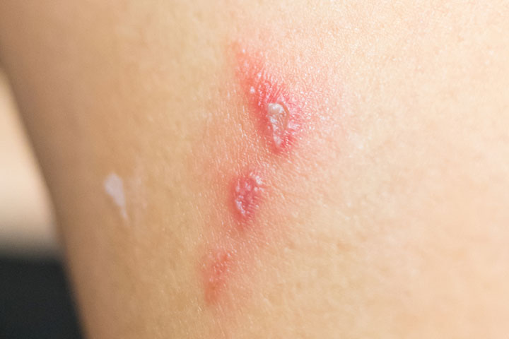 secondary bacterial infection due to scabies