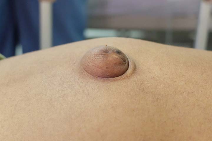 A belly button protruding outwards may indicate an umbilical hernia.