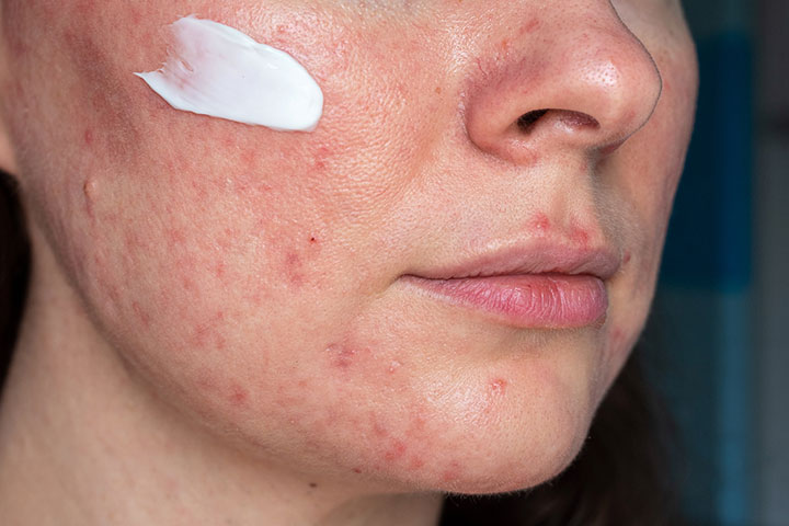 A doctor may prescribe ointments to treat acne while breastfeeding