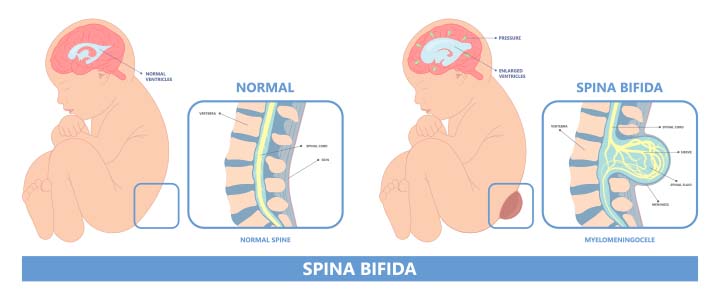 Abnormalities of the neonatal spinal column