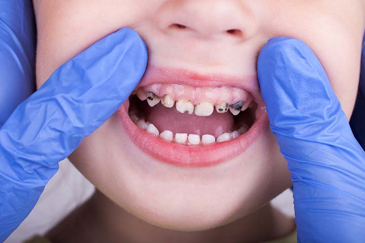 Abscess tooth while pregnant increases the risk of childhood tooth decay