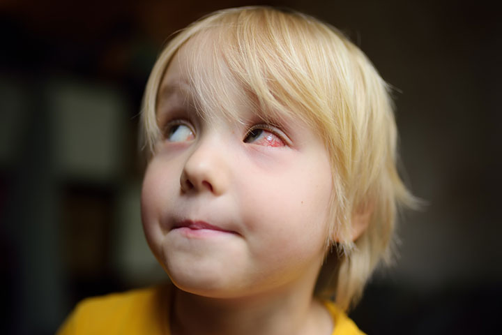 Allergies may cause watery eyes in children