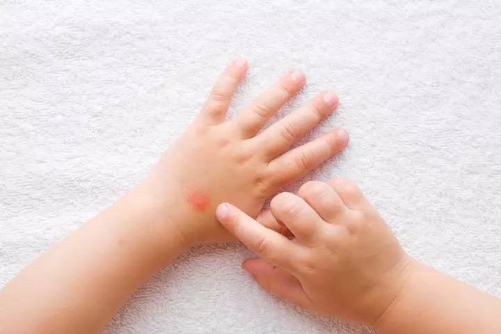 Apply ice on the mosquitoe bites in toddlers