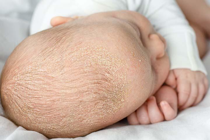 Atopic dermatitis can cause scales on the baby's scalp