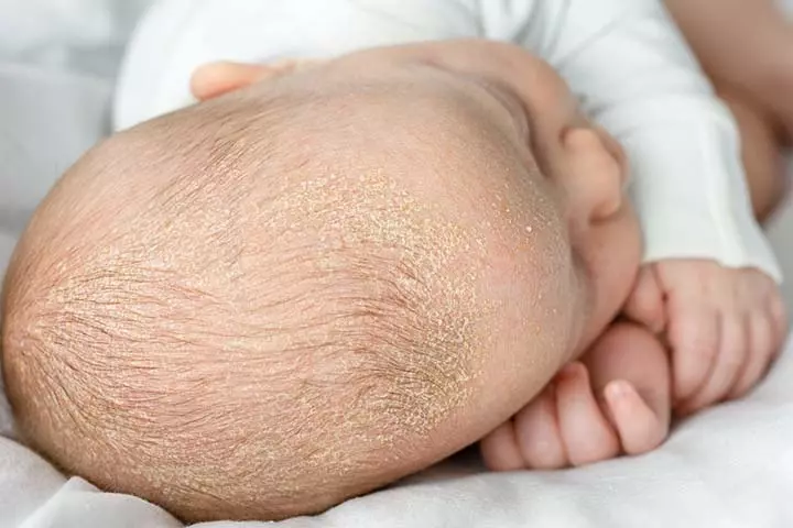Atopic dermatitis can cause scales on the baby's scalp