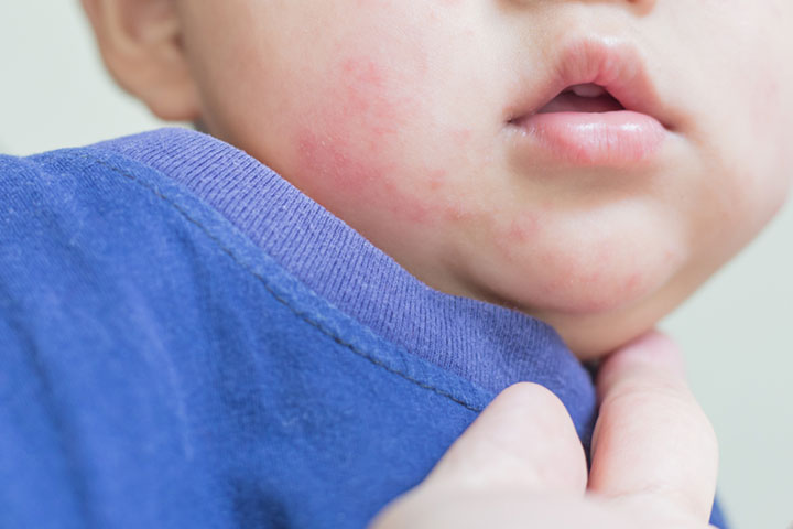 Avoid giving blackberries to babies who are allergic to them