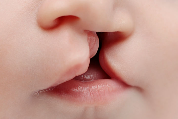 唇裂的婴儿有咀嚼困难