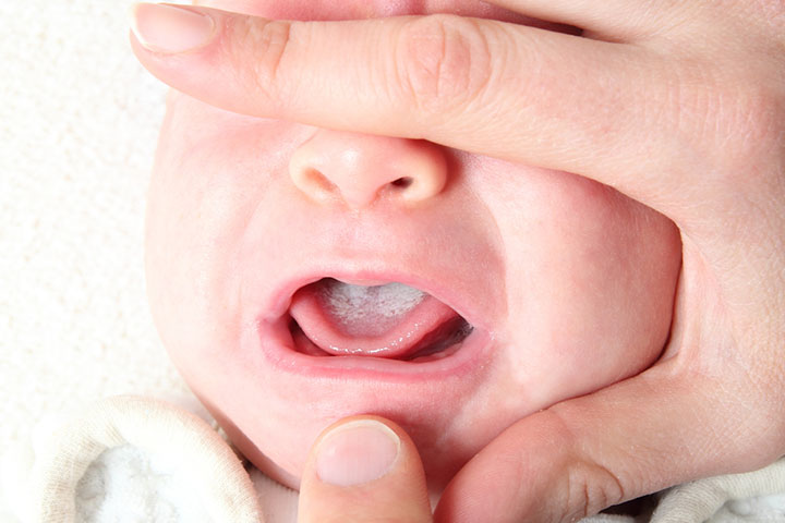 Babies with oral thrush may have difficulty breastfeeding