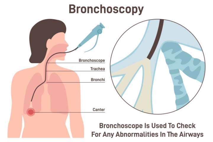 Bronchoscopy helps identify lesions and collect tissue samples for biopsy.