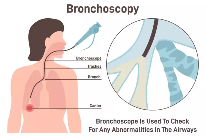 Bronchoscopy helps identify lesions and collect tissue samples for biopsy.