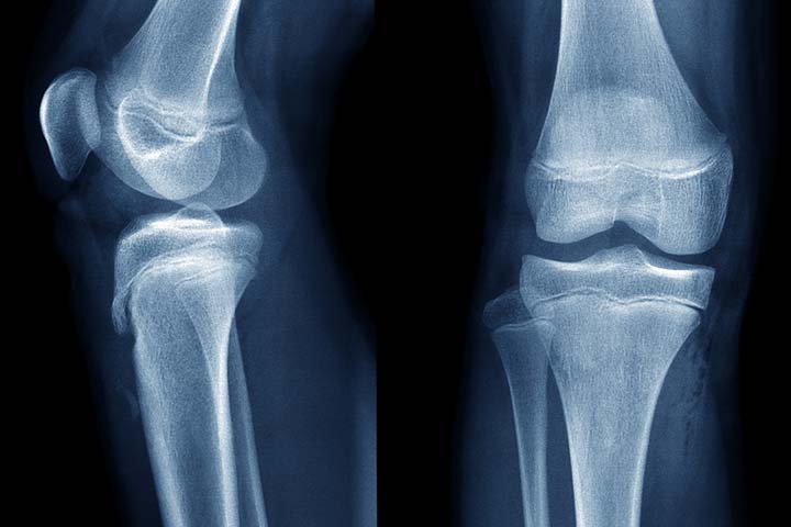 CT scans can detect bone deformities in a child